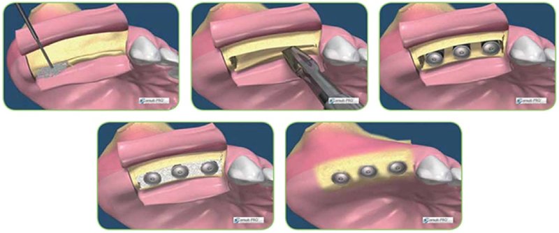 Implantologie - clinica stomatologie